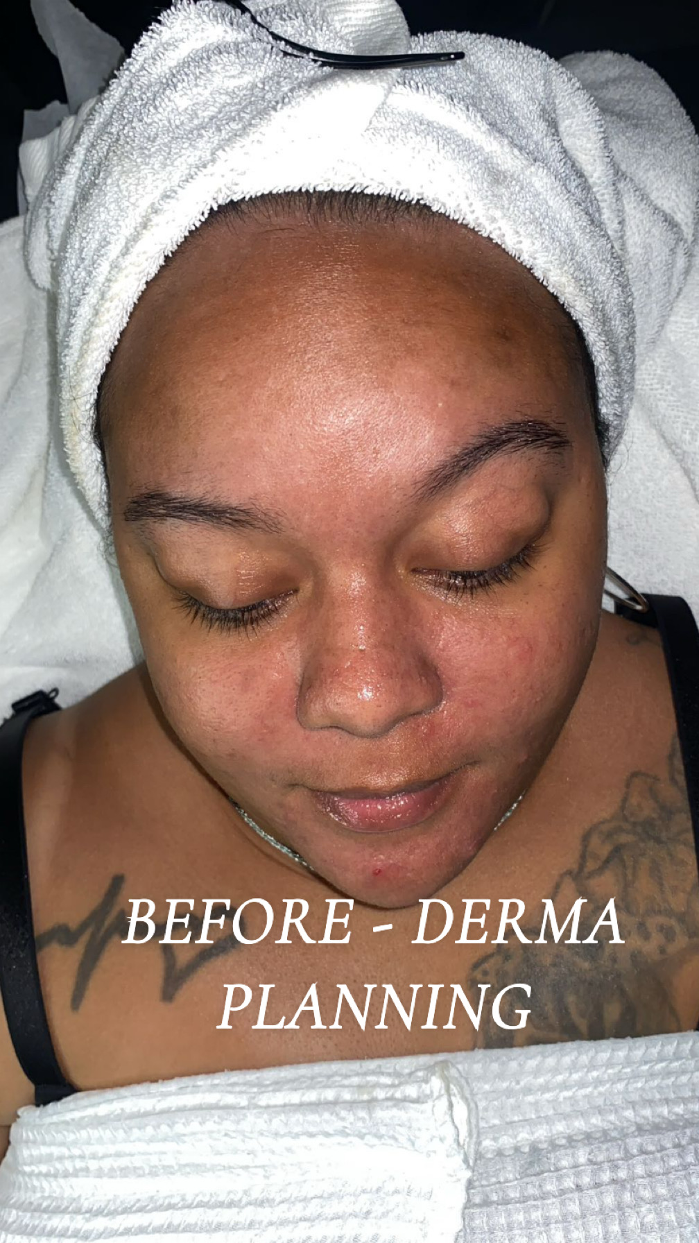 Client's skin before a dermaplaning treatment at Peaches Skin Studio