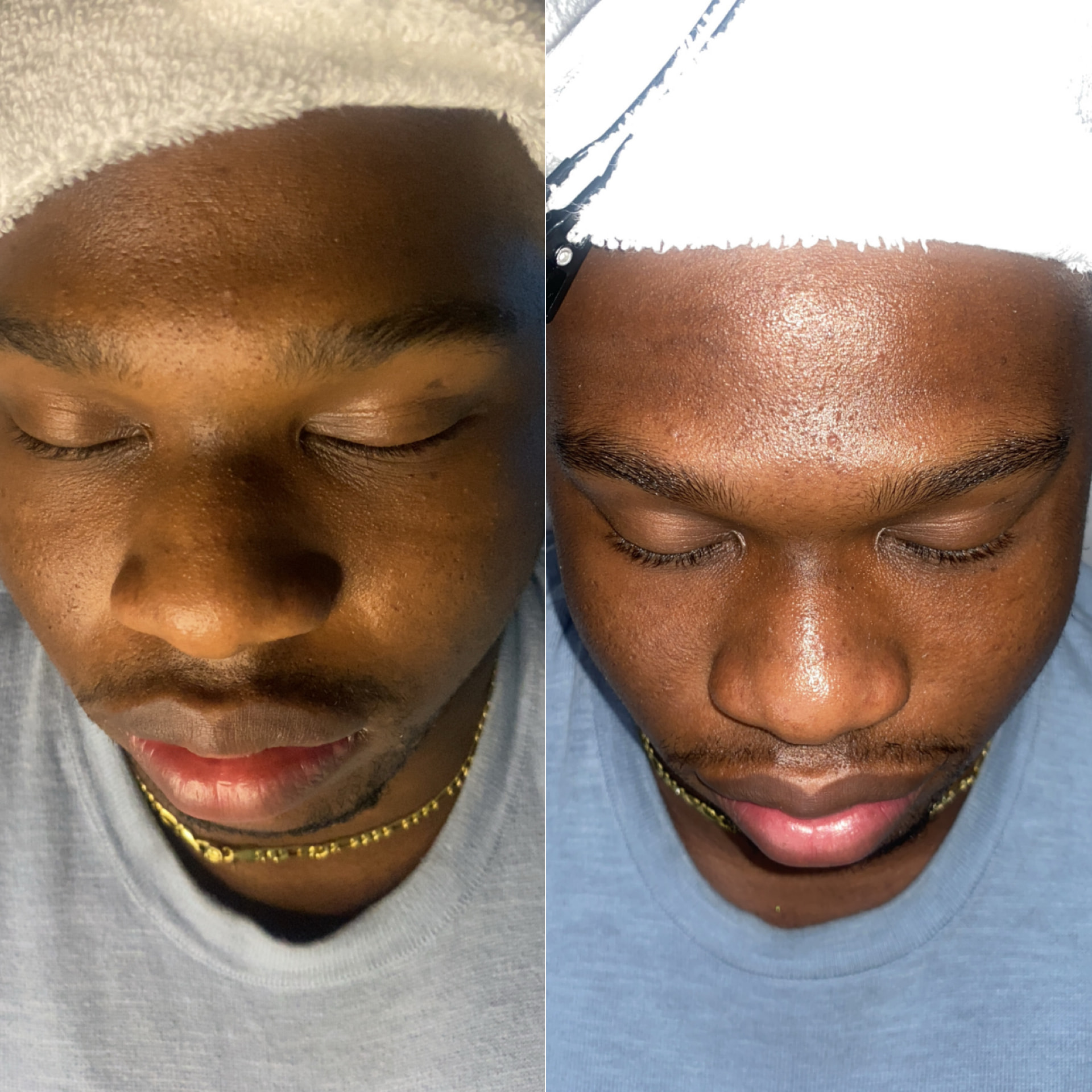 Side-by-side before and after of a clarifying facial for textured skin