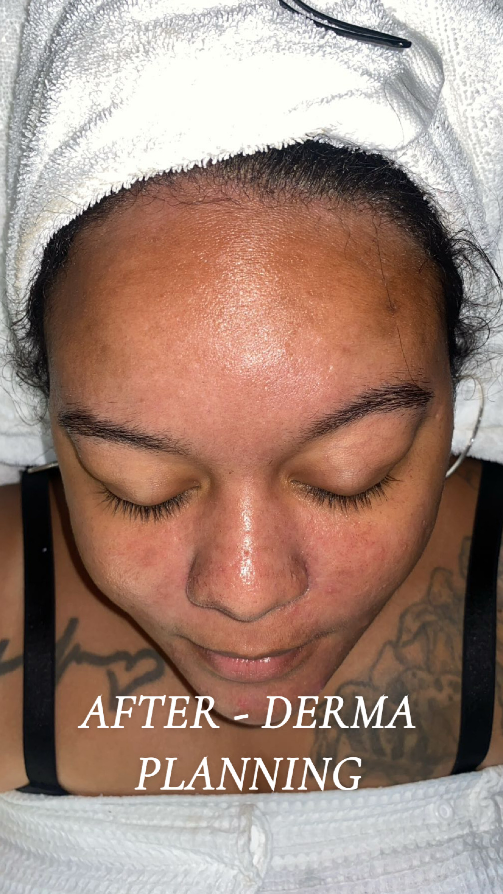 Client's smooth, glowing skin immediately after dermaplaning